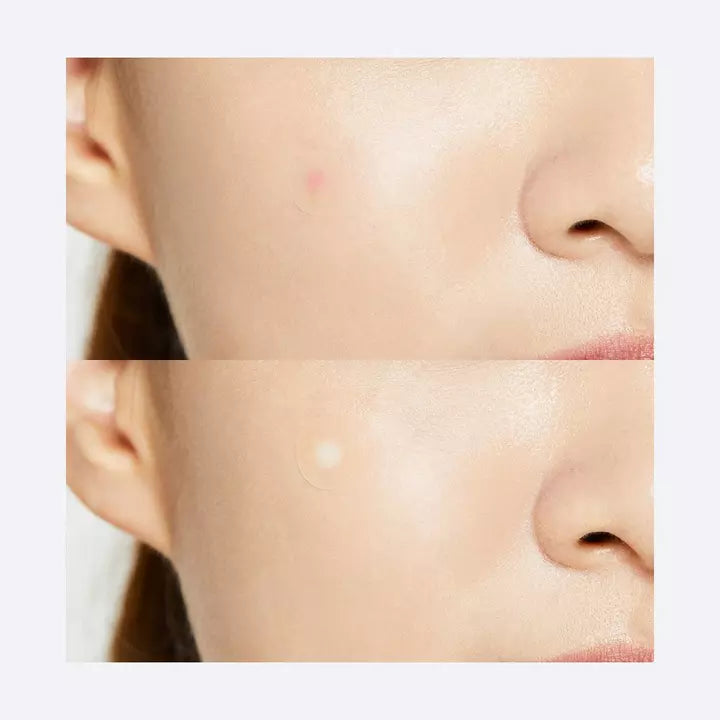 COSRX Acne Pimple Master Patch 24pcs – изображение 7 | NetTrade.ee